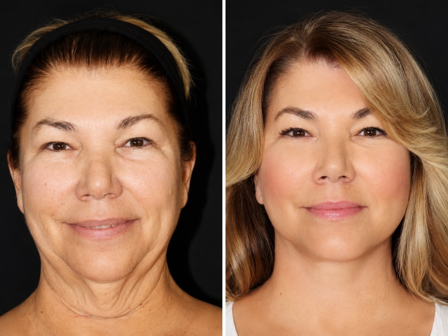 Facial aesthetics result 1