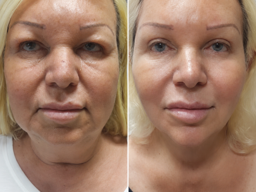 Facial result 2