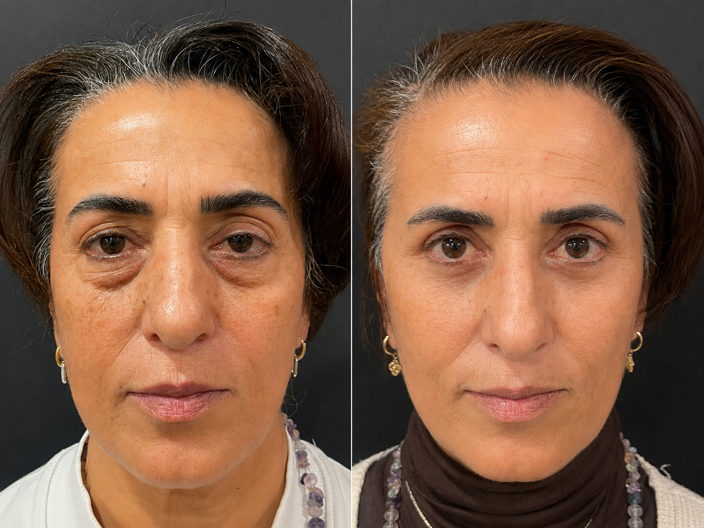 Facial aesthetics result 3