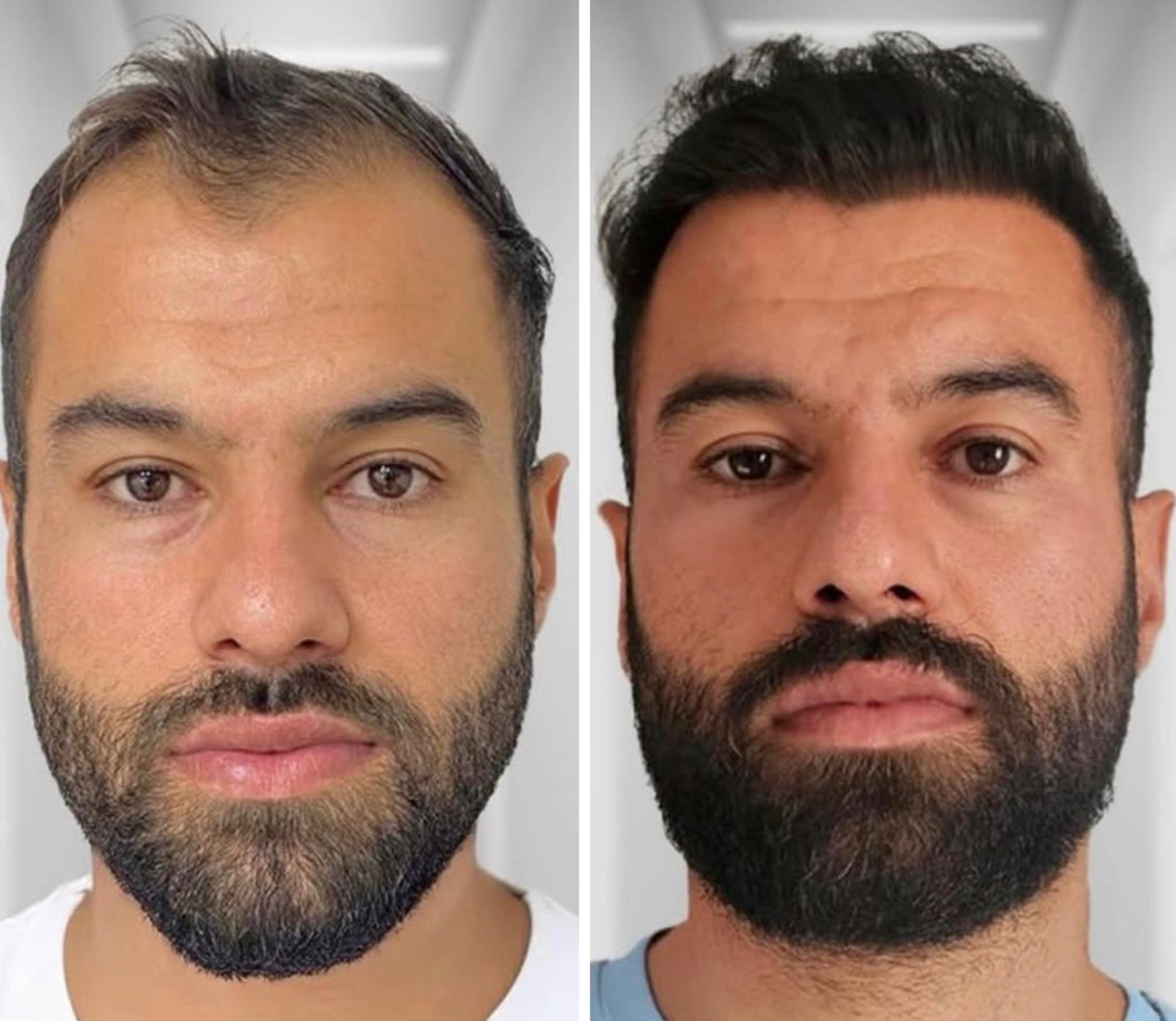 Hair transplant result 3