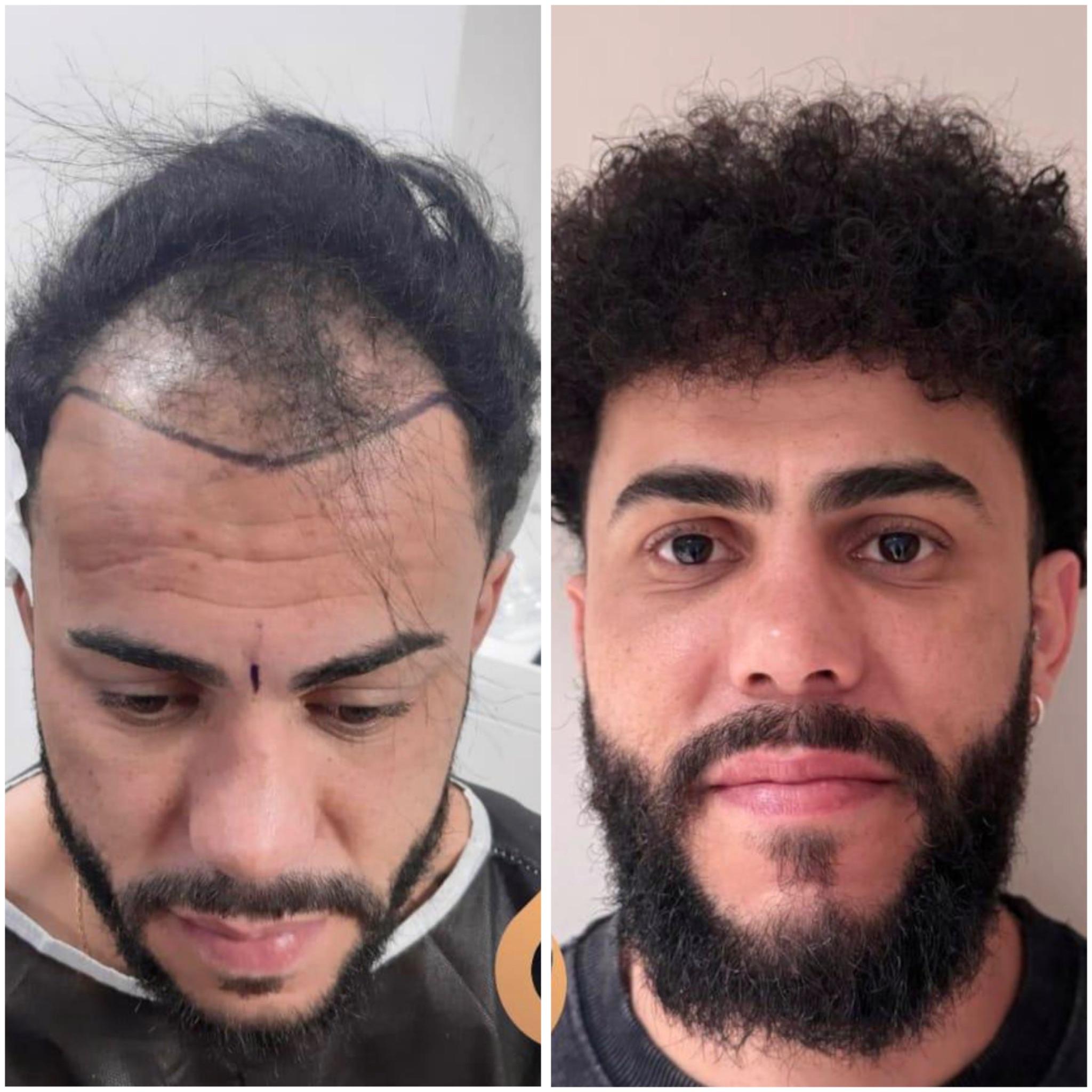 Hair transplant result 6