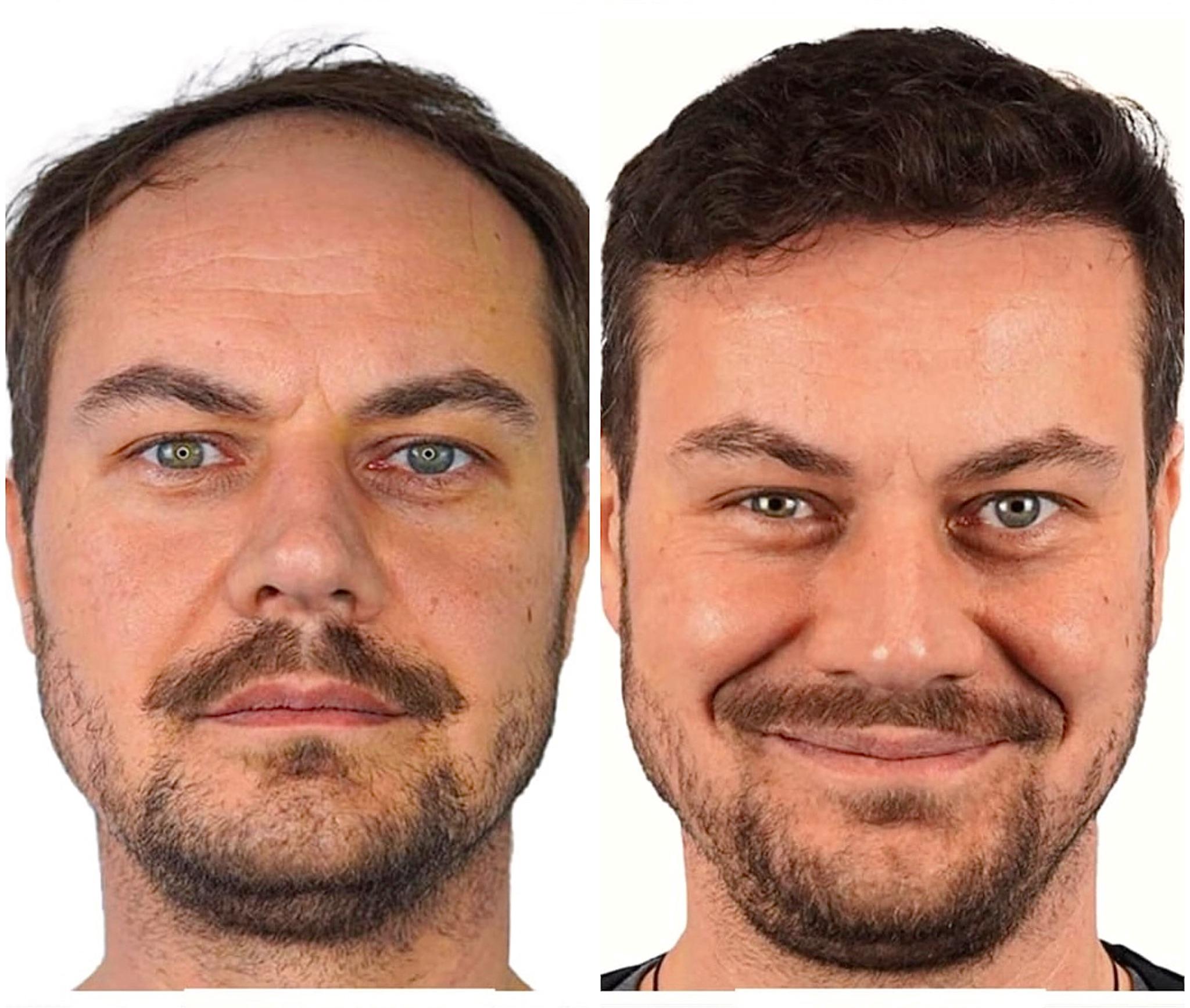 Hair transplant result 8