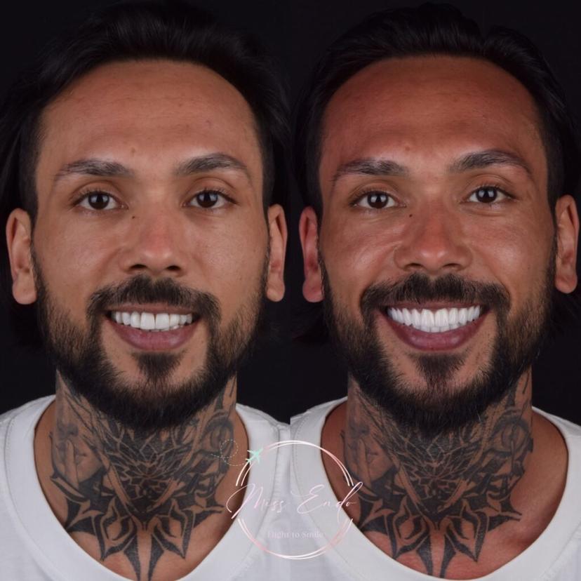 Dental smile makeover 2