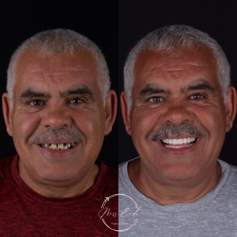 Dental smile makeover 4