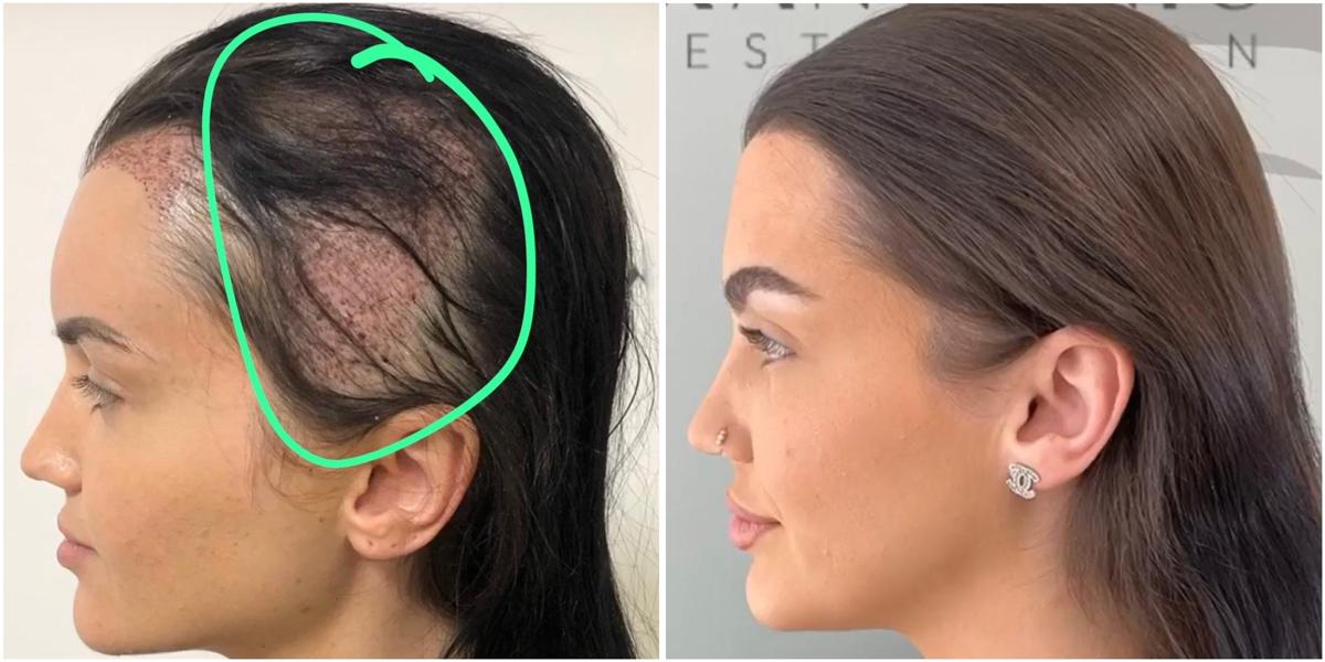 Hair transplant result 2