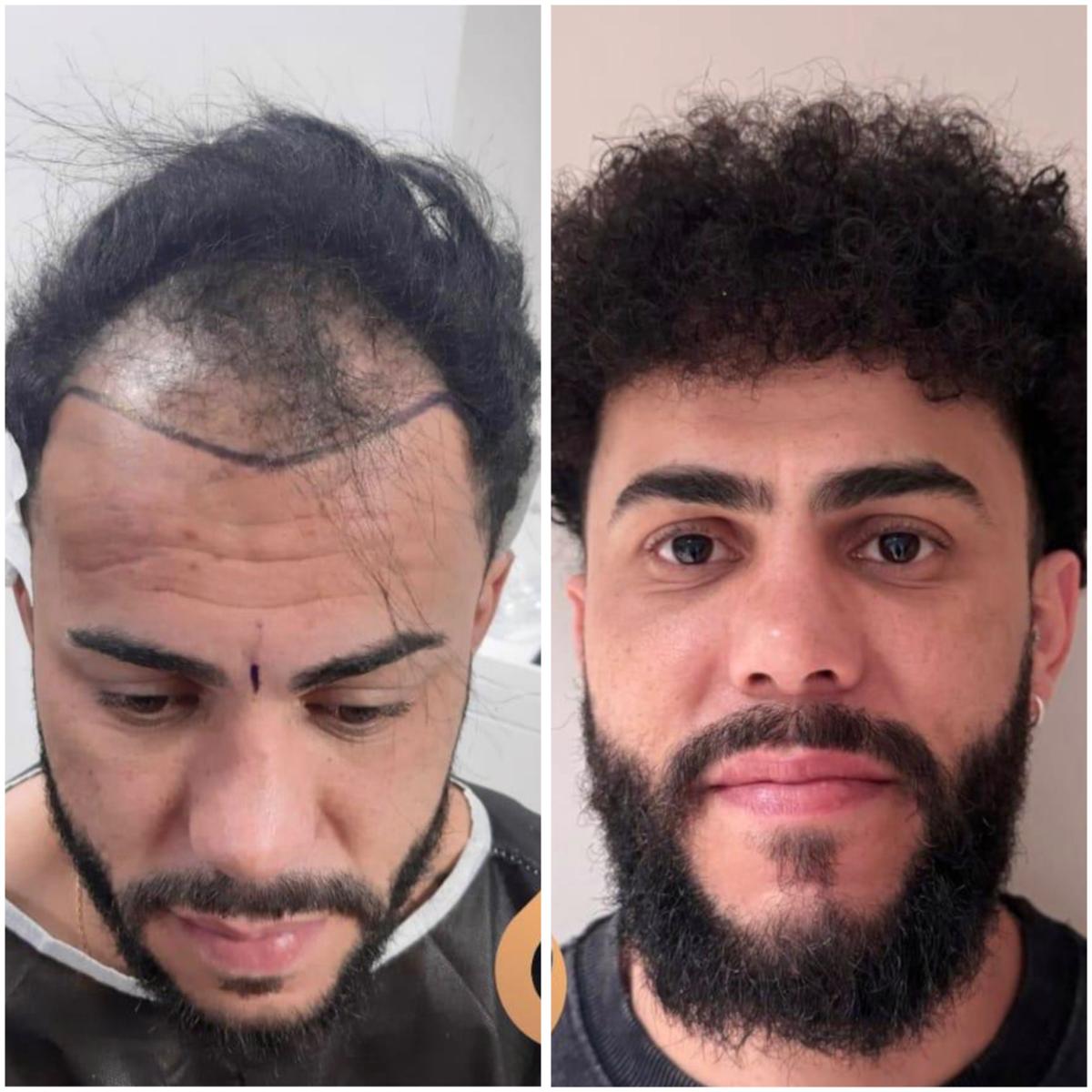 Hair transplant result 3