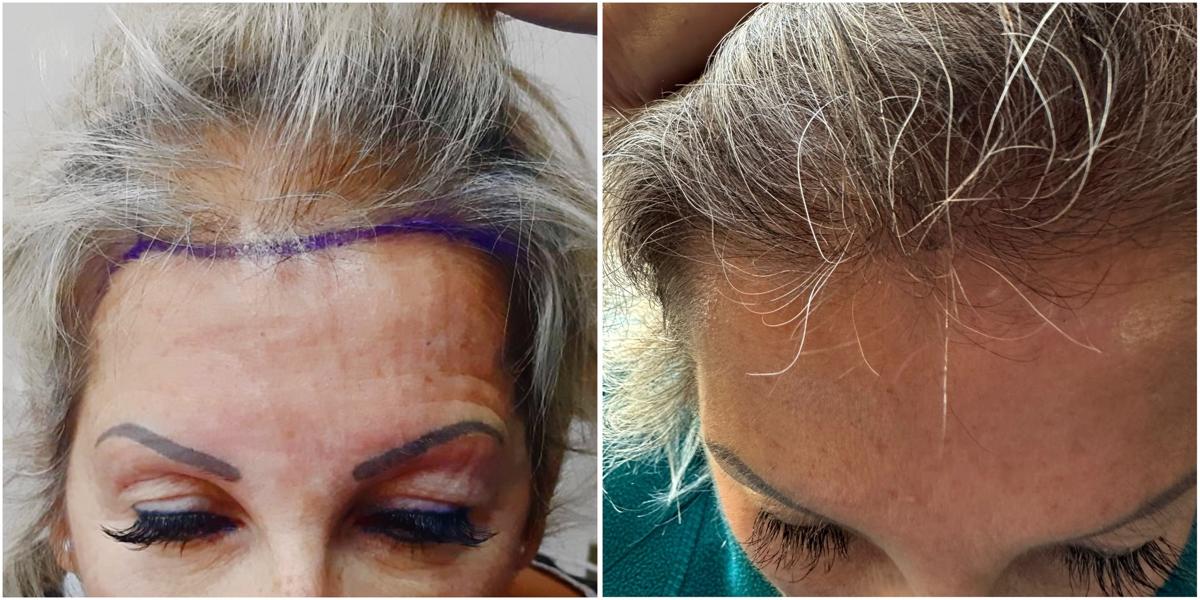 Hair transplant result 5