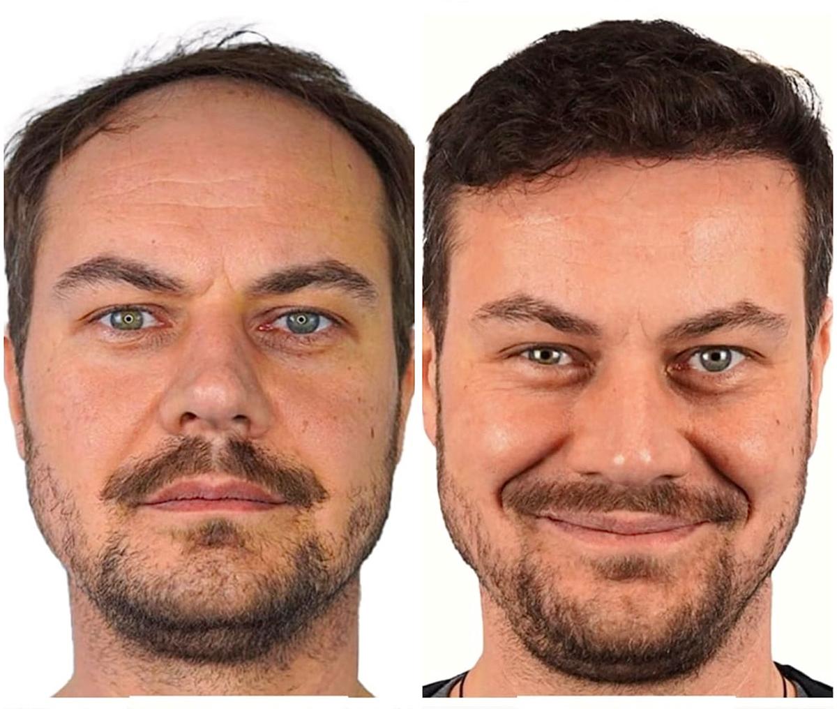 Hair transplant result 6